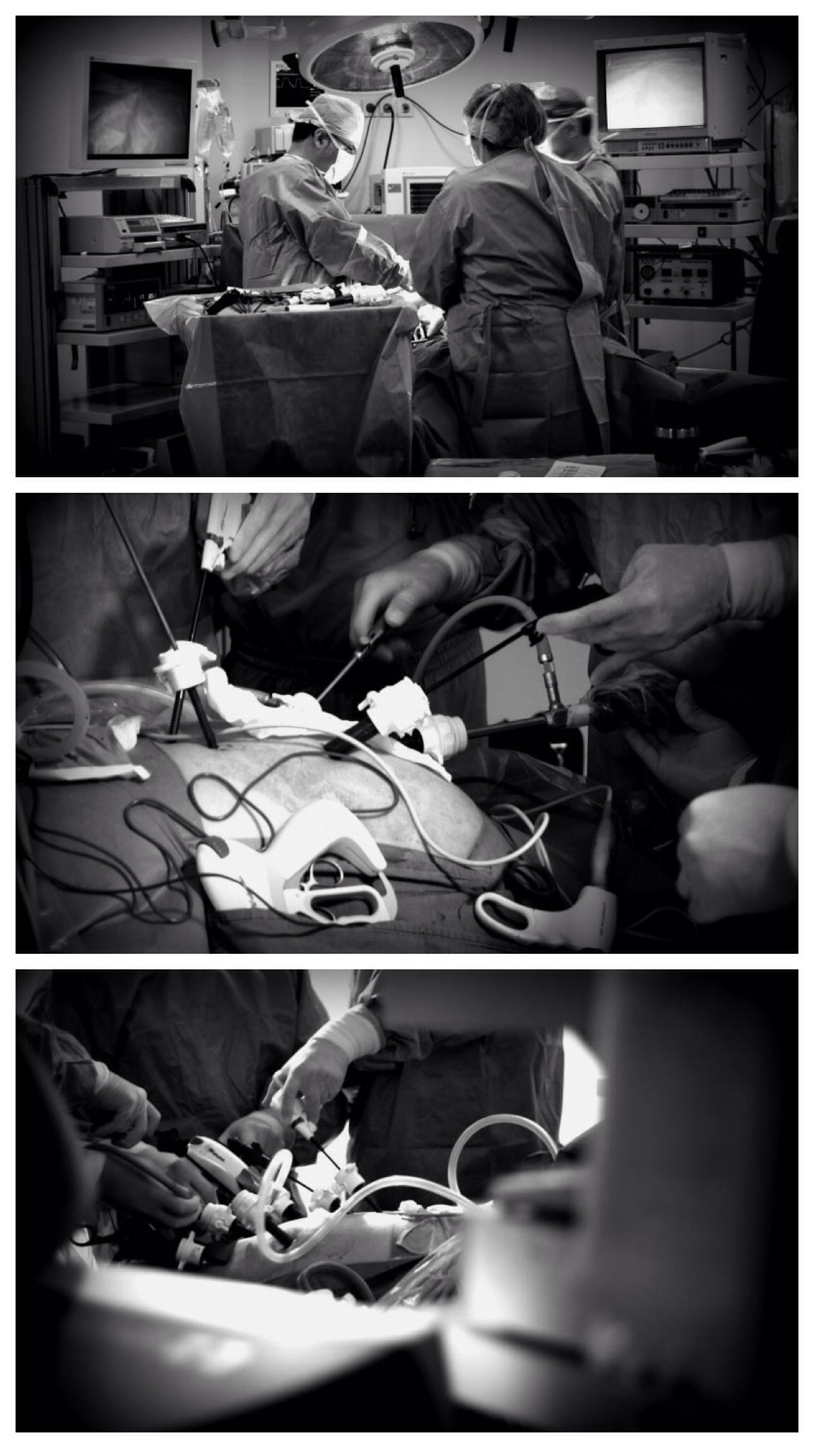 Treatment of Type 2 Diabetes Mellitus in Turkey (ileal interposition surgery)
