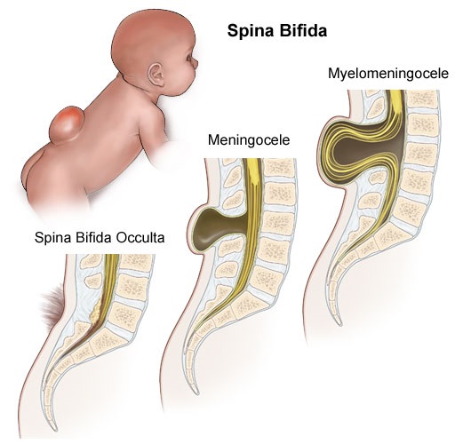 Treatment of children diagnosed as Spina Bifida (clinic in Israel)